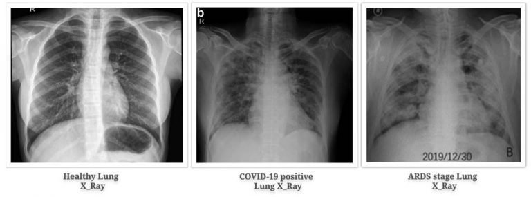 Prognosis of COVID19 with Slender Prospect of
